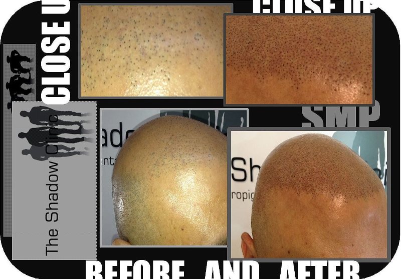 Scalp Micro Pigmentation Treatment by The Shadow Clinic