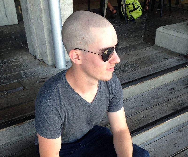 Scalp Micro Pigmentation Australia